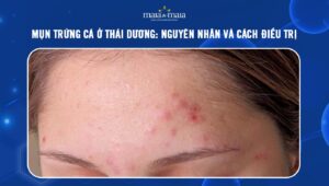 mụn trứng cá ở thái dương