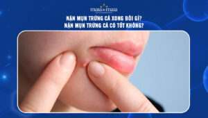 nặn mụn trứng cá xong bôi gì