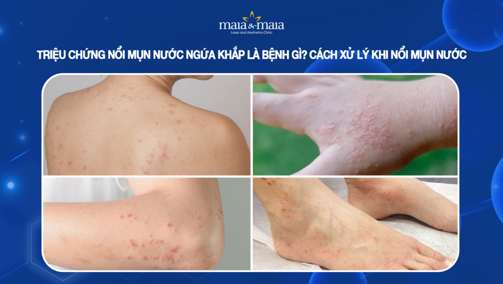 nổi mụn nước ngứa khắp người