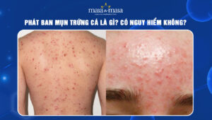 phát ban mụn trứng cá