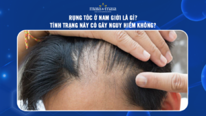 rụng tóc ở nam giới