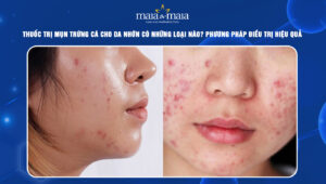 thuốc trị mụn trứng cá cho da nhờn