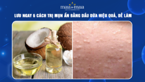 trị mụn ẩn bằng dầu dừa