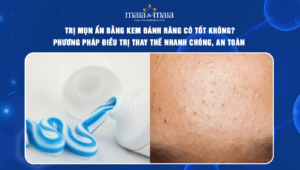 trị mụn ẩn bằng kem đánh răng