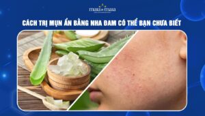 trị mụn ẩn bằng nha đam