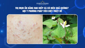 trị mụn ẩn bằng rau diếp cá