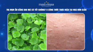 trị mụn ẩn bằng rau má
