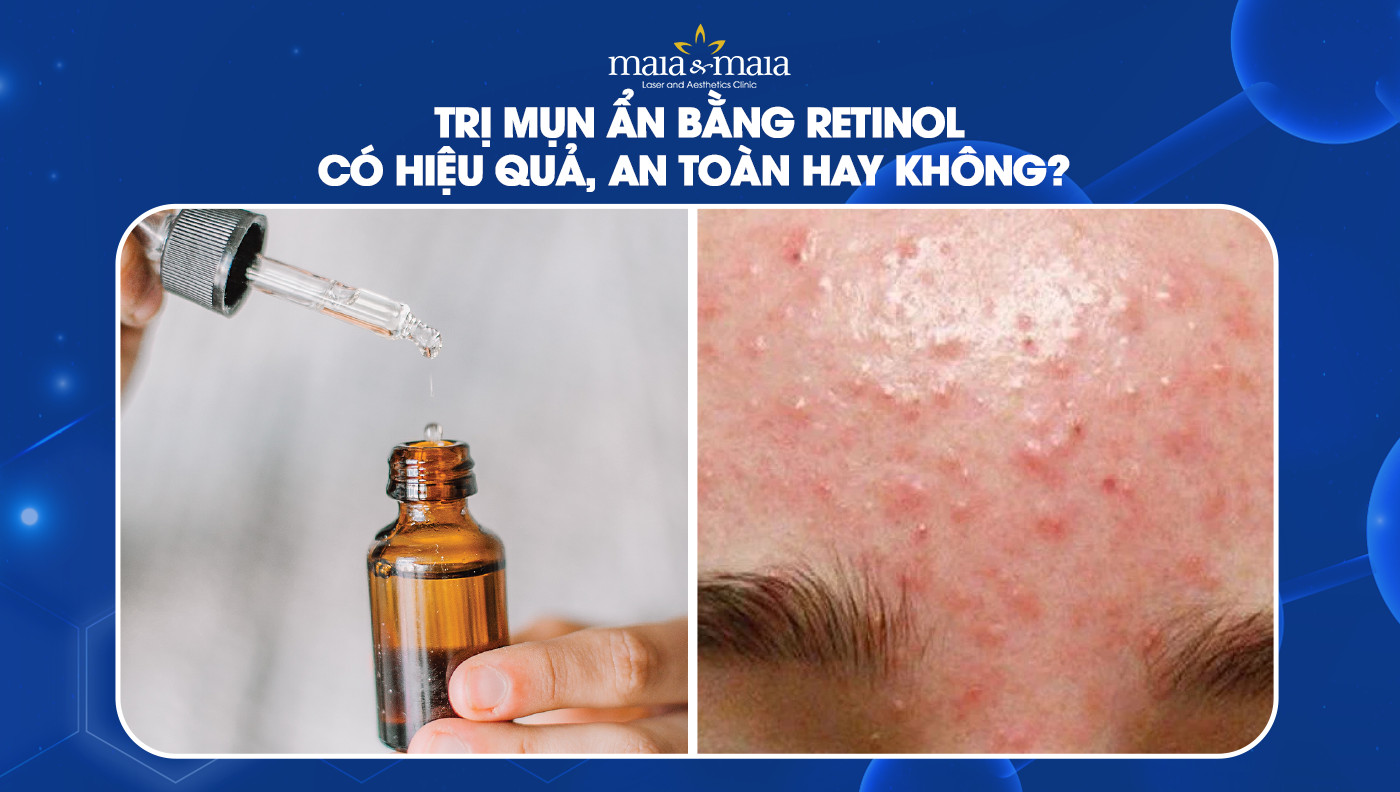 Trị Mụn Ẩn Bằng Retinol: Giải Pháp Hiệu Quả Cho Làn Da Mịn Màng