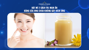 trị mụn ẩn bằng sữa ong chúa