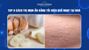 trị mụn ẩn bằng tỏi