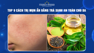 trị mụn ẩn bằng trà xanh