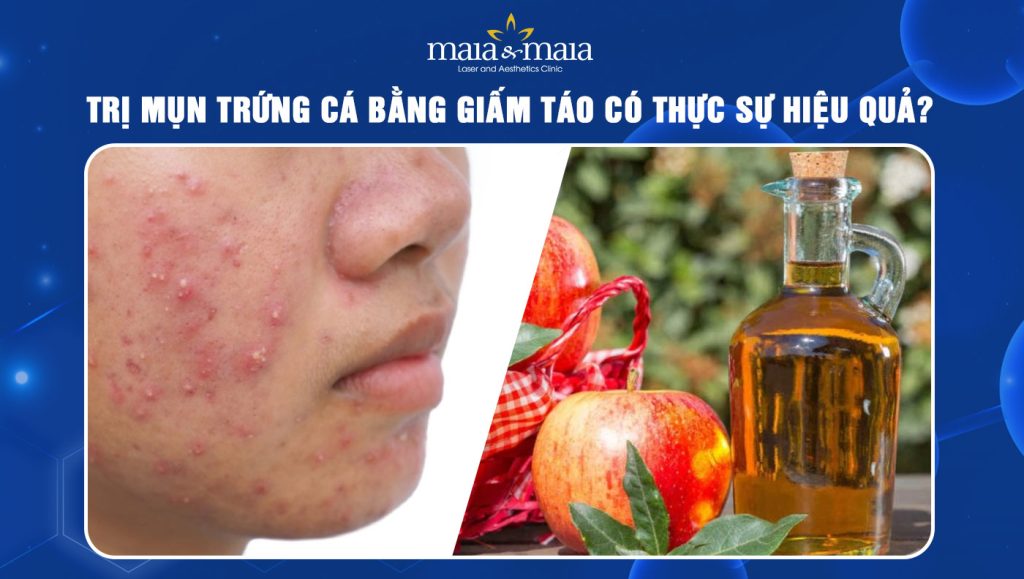 trị mụn trứng cá bằng giấm táo