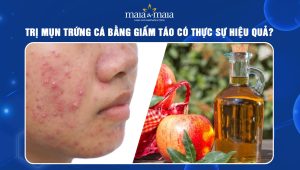 trị mụn trứng cá bằng giấm táo
