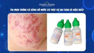 trị mụn trứng cá bằng hồ nước