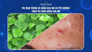 trị mụn trứng cá bằng rau má