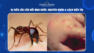 bị kiến lửa cắn nổi mụn nước