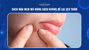 cách nặn mụn mủ