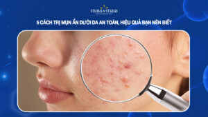 cách trị mụn ẩn dưới da