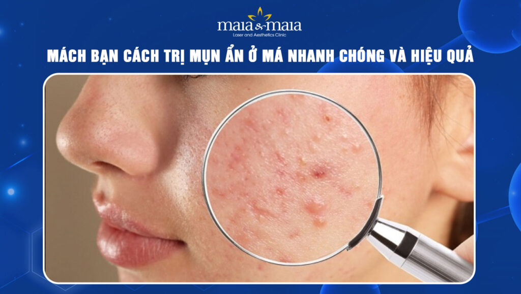 cách trị mụn ẩn ở má