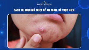 cách trị mụn mủ