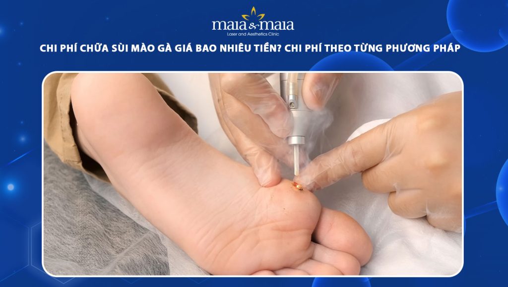 Chi phí chữa sùi mào gà giá bao nhiêu tiền? Bảng giá chi tiết theo từng phương pháp 1 chi phí chữa sùi mào gà