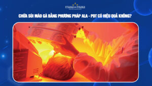 Chữa sùi mào gà bằng phương pháp ALA-PDT