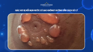 giác hơi bị nổi mụn nước