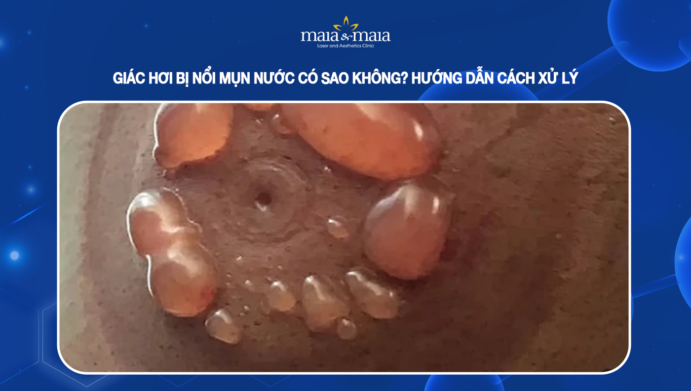 4. Cách phòng ngừa mụn nước khi giác hơi