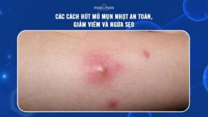 hút mủ mụn nhọt