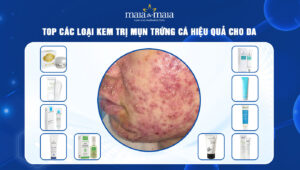 kem trị mụn trứng cá