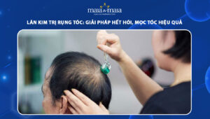 lăn kim trị rụng tóc
