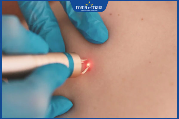 laser co2 đốt sùi mào gà