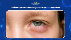 mí mắt nổi mụn nước