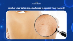 mụn ẩn ở lưng