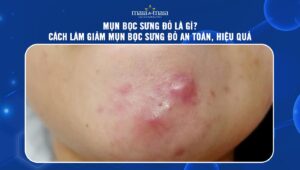 mụn bọc sưng đỏ