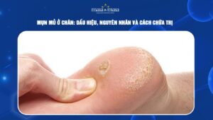 mụn mủ ở chân