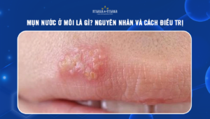 mụn nước ở môi