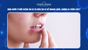 mụn nước ở môi kiêng ăn gì