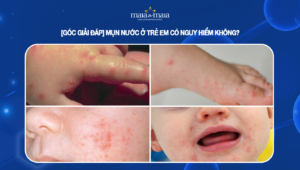 mụn nước ở trẻ em