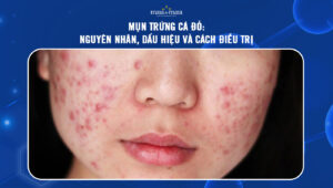 mụn trứng cá đỏ