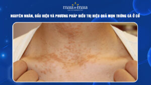 mụn trứng cá ở cổ