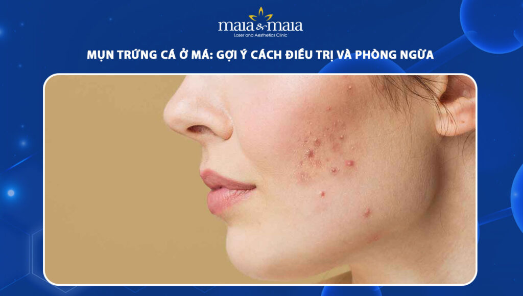 Mụn trứng cá ở má: Gợi ý cách điều trị và phòng ngừa 1 mụn trứng cá ở má