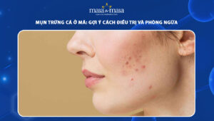 mụn trứng cá ở má