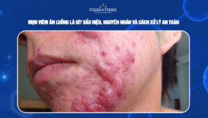 mụn viêm ăn luồng