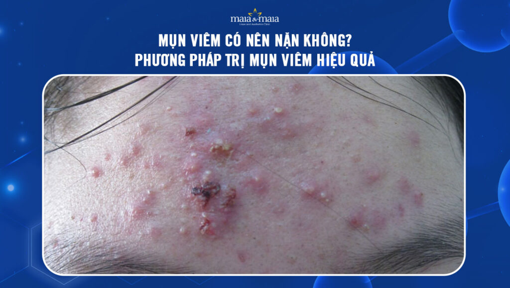 mụn viêm có nên nặn không