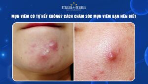 mụn viêm có tự hết không