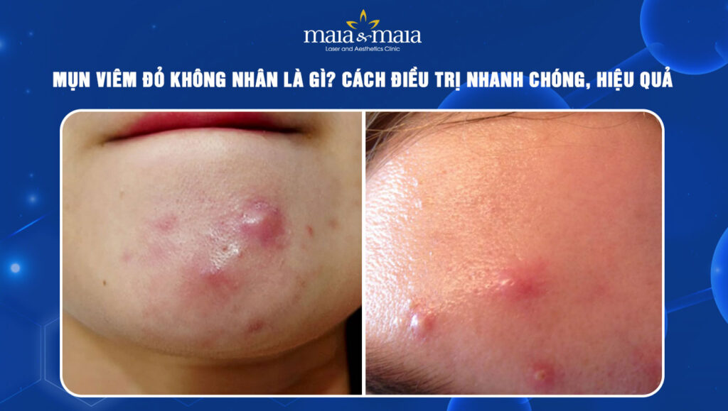 mụn viêm đỏ không nhân