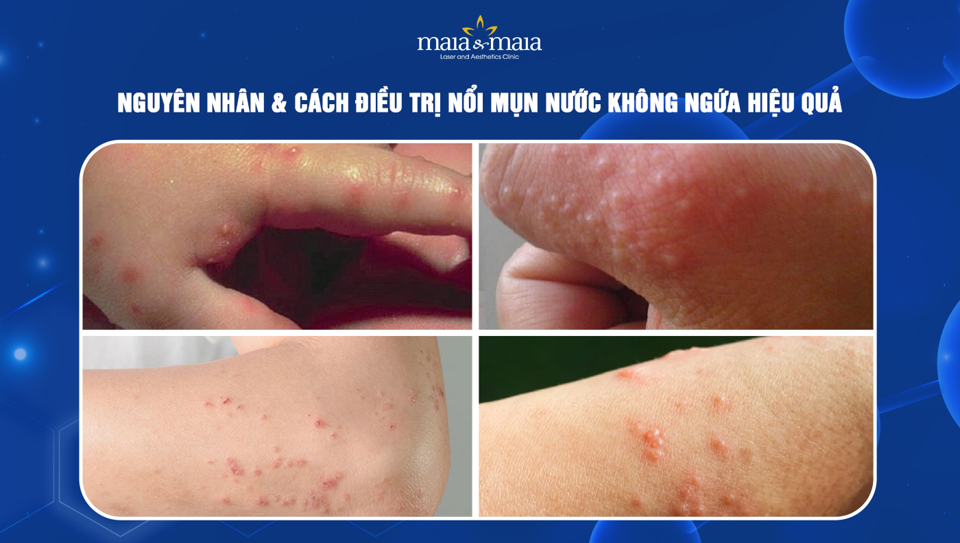 4. Biện pháp điều trị và chăm sóc mụn nước không ngứa