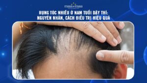 rụng tóc nhiều ở nam tuổi dậy thì