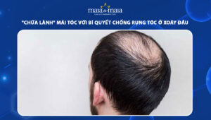 rụng tóc ở xoáy đầu